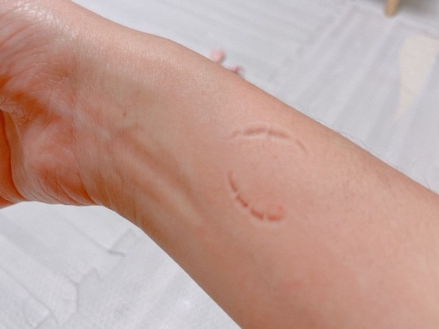 痛みに耐える中で腕についた爪痕