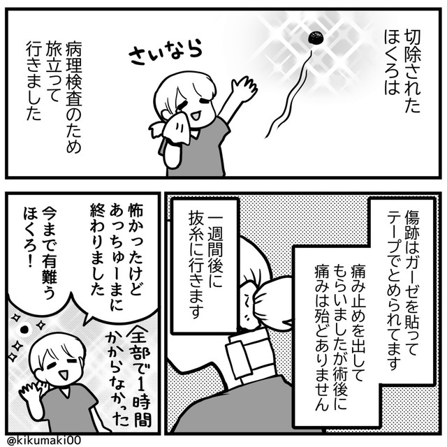 約1時間でほくろ切除（きくまきさん提供）