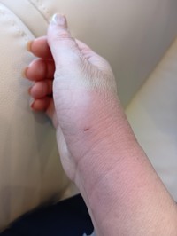 猫に噛まれた傷跡